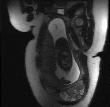 MRI of the Fetal BrainAdvancements in MRI are giving us an unprecedented look at the fetal brain.Unt