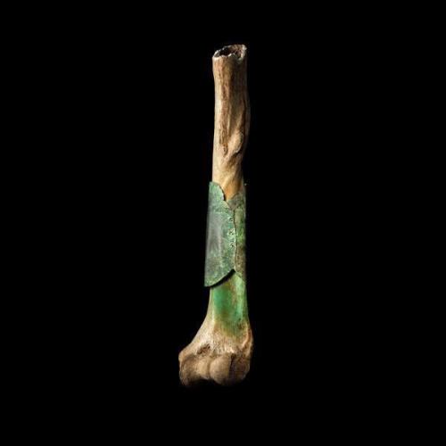 ardarte: sixpenceee: A medieval surgeon repaired this broken bone with riveted copper plate. &a