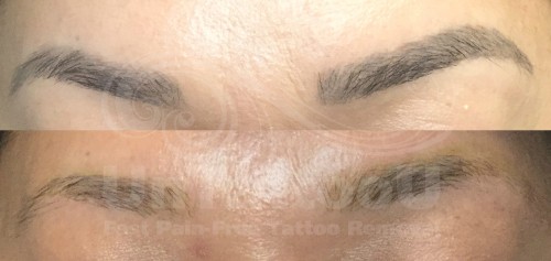 UnTattooU: Laser Tattoo Removal Professionals — UnTattooU: Permanent Makeup  Removal BEFORE & AFTER...