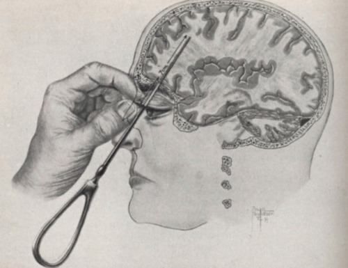 deejaytaco:LobotomyThe idea behind psychosurgery is that severe forms of mental illness (schizophren