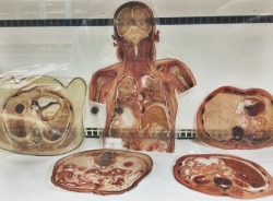 chipslaysandcheetos:  Slices of human organs