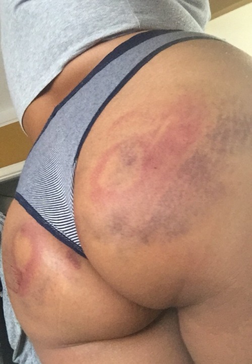 justadumbbaby: ouch❣️