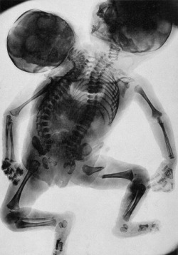 odd-titties: An x-ray of conjoined twins born with two backbones and two heads. 