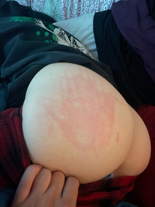 Pretty Pretty Marks From Last Night