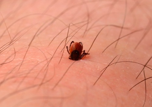 Photograph Of A Deer Tick Embedded In A Man’s Skin.