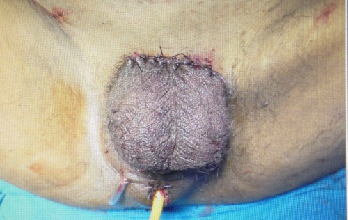 penectomies:total penectomy due to necrosis after gunshot wound