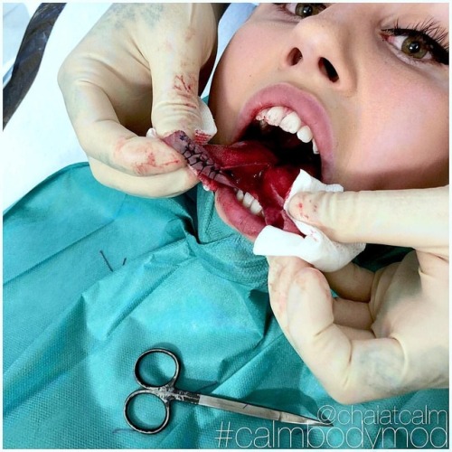 chaiatcalm:More mid-procedure pictures as requested! Here’s when I performed @emelielindbergg’s #ton