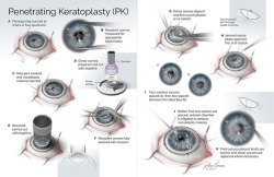 julialerner:  Penetrating keratoplasty, also known as a corneal transplant. A diseased or damaged cornea is replaced with graft tissue from a donor. The sutures stay in for around a year. I chose a blue iris to make them more visible. The procedure was