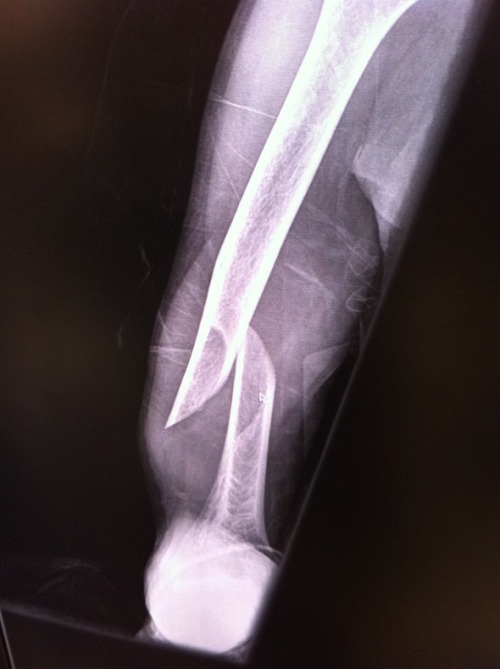 emt-monster:  Humerus fracture. It’s not funny. (Well maybe a little bit)  Source: lifeinthefastlane 