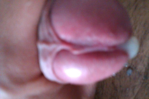 exposedwiresandstrings:  I tore my frenulum once, and after it healed it looked kind of like a shark