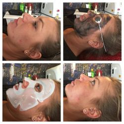 Carbon laser facial done this afternoon! 1st picture before going through the process then after 1st treatment #skinrejuvenation #carbonfacial #tattooremoval #collagenfacialmask #beauty by charleyatwell