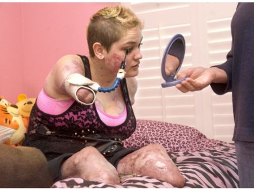 Lost her limbs due to contracting bacterial meningitis. I don’t think I’ve ever seen thi