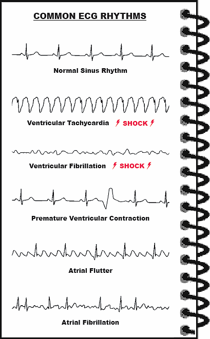 rightatrium:  Common EKG Rhythms