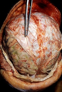 Just Beneath The Skull Is A Tough, Leathery Layer Called The Dura Mater.