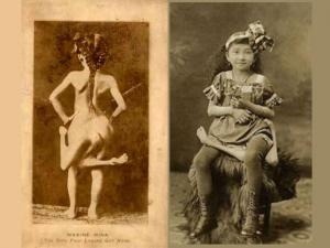 Maxine Mina was born in the philippines in 1896. She was born with a parasitic twin