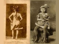 Maxine Mina Was Born In The Philippines In 1896. She Was Born With A Parasitic Twin