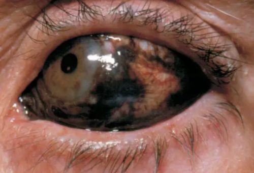 sweetdeffectt: Malignant melanoma of the conjunctiva presents as a raised, pigmented or nonpigmented