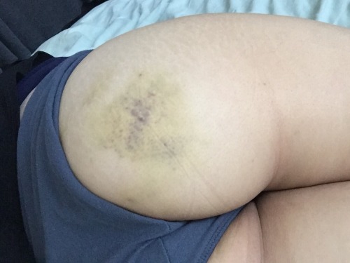 kneehighsandlows: Healing. Love marks