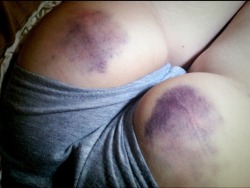 master-randy-paul:  Bruised bottom. She feels her Master’s touch.  