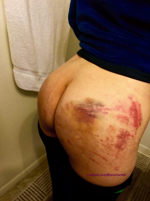 leatherlacedbass:Spank me! ❤️ Bruises aftermath from the St. Andrews Cross at the BDSM Rave. 💖 🎶 Marks and bruises courtesy of my friends and Master. I have a bruise the whole length on my hip the whole outline of my crop 😻💋😈Other posts