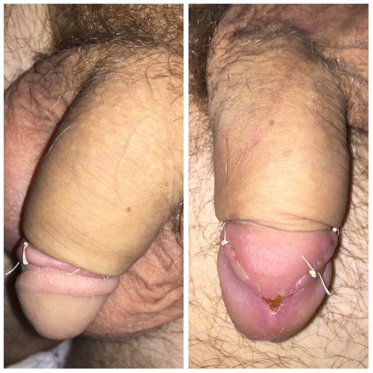 cutthecock:  Day 10 post op: no changes.  An interesting method of circumcision by