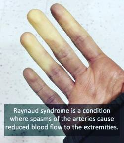 doctordconline: Raynaud’s disease is a rare disorder of the blood vessels, usually in the fingers and toes. It causes the blood vessels to narrow when you are cold or feeling stressed. When this happens, blood can’t get to the surface of the skin