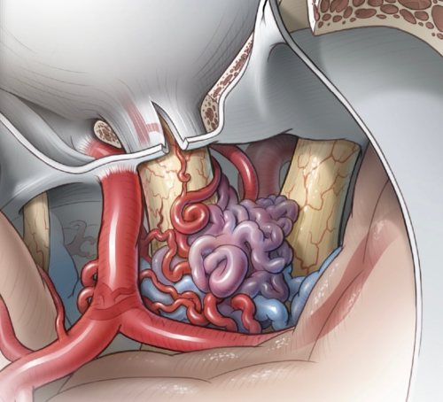 New article published in the Journal of Neurosurgery this month titled “Arteriovenous malforma