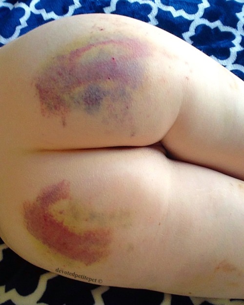 devotedpetitepet:  Thanks to @jack-writes for my  bruises. The one on my right cheek looks like a nebula ☺️. I also have some lovely light bruises on the tops of my thighs.