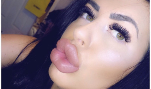 plasticpornslut:philuranus:modern-femininity:Lip FillerLip filler is a lot cheaper than fake tits.Li