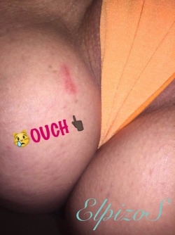 elpizos:  Ouchies!!! 😿👎🏿👎🏿👎🏿 Even inanimate objects are trying to nibble at my sweet cheeks. First my bed bites my booty cheek and then my toilet seat bites my juicy thigh!  #sweetness