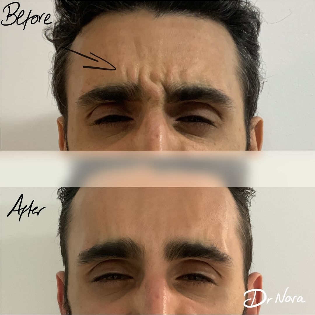 Anti-wrinkle treatment of the frown ðŸ˜²Anti-wrinkle therapy is a way to reduce the appearance of strong and deep lines. Treatment time is 15 minutes, optimal results are seen at 2 weeks and lasts up to 3-5 months.
If you have any questions or would...