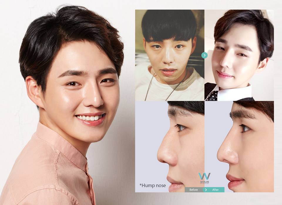 Bye Hump Nose! [Best Rhinoplasty in Korea] Certain... - Wonjin Plastic