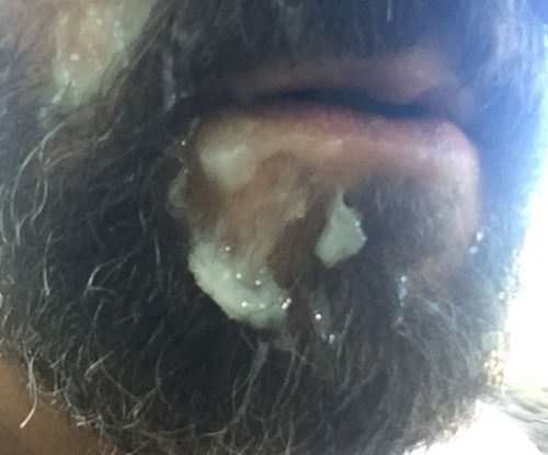 Beardburnme