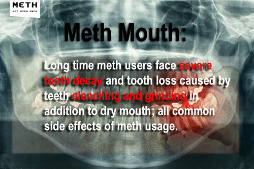 Meth Mouth is  the term used to refer to the tooth decay and erosion that a meth abuser experiences 