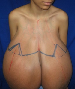 Real Life Big Breasts #2Beautiful young woman with virginal breast hypertrophy - Medical Photo(So&hellip; if she is not like the others, we just cut her up?)