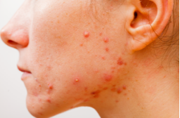 Why You Should See a Dermatologist for Your Acne Treatment