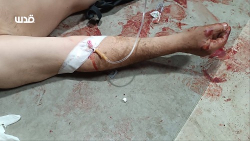 🚨 Earlier This Morning, Over 70 Palestinians Were Martyred, And Over 250 Wounded, After The IOF Opened