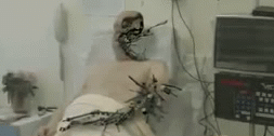 sixpenceee:  Metalosis Maligna is a fake disease invented by award-winning Dutch