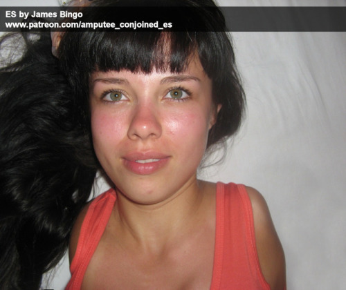 amputee-and-conjoined-porn: Please Reblog My Patreon Page: Amputee Conjoined ES  So sweetie
