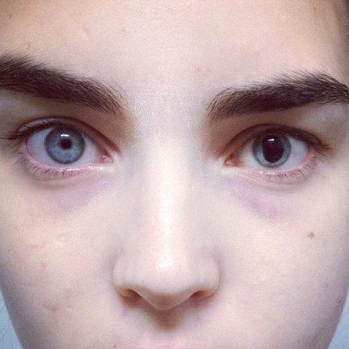 qoax:  alimichael-instagram:  Ali Michael before her eye surgery    wa