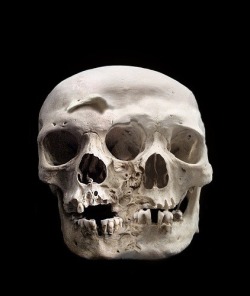 victoriana1313:  Fused skulls on display