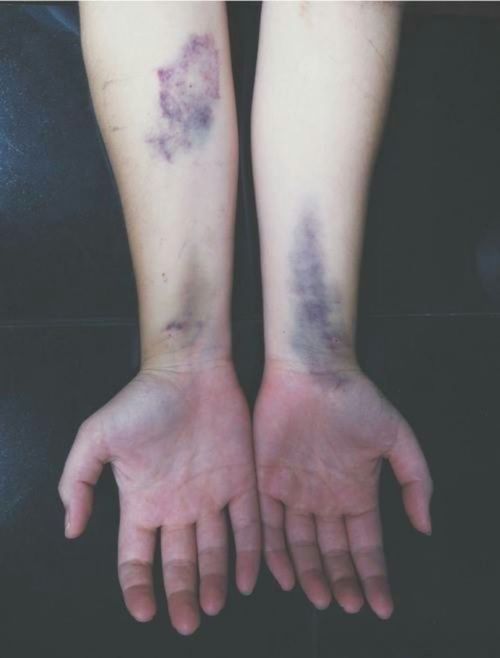 fetka: bruise en We Heart It - weheartit.com/entry/119582546