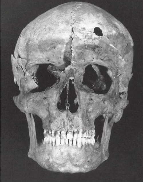 deathandmysticism:Skull of a pioneer with a gunshot wound, Wyoming, late 19th century