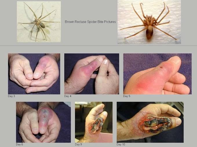 Interesting:
Around 49% of brown recluse bites do not result in necrosis or systemic effects. When both types of loxoscelism do result, systemic effects may occur before necrosis, as the venom spreads throughout the body in minutes. Children, the...