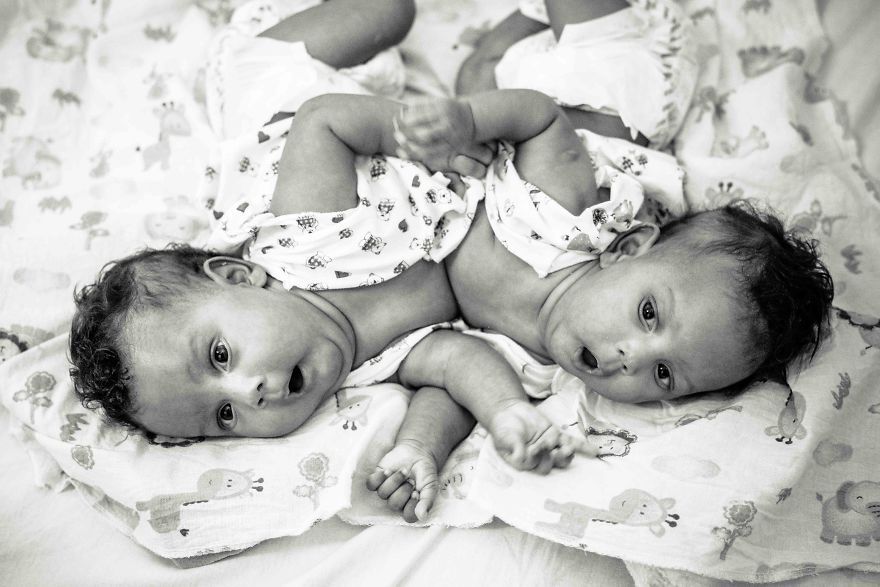 sixpenceee:  Conjoined infants survive life-Or-death SurgeryThe twin infants, Maria