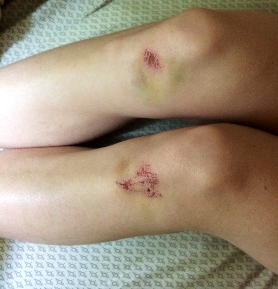 diet-coke-and-batmans-love:  Why you should never piggy back someone in heels after