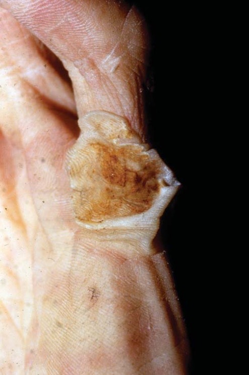 doctorforensic: Electrical burn on this individual’s hand who reached into a ceiling and grabb