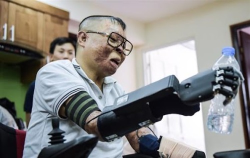 Vietnamese pilot receives 3D printed bionic hand after aircraft crash A Vietnamese military pilot has… https://ift.tt/2HtVIiX