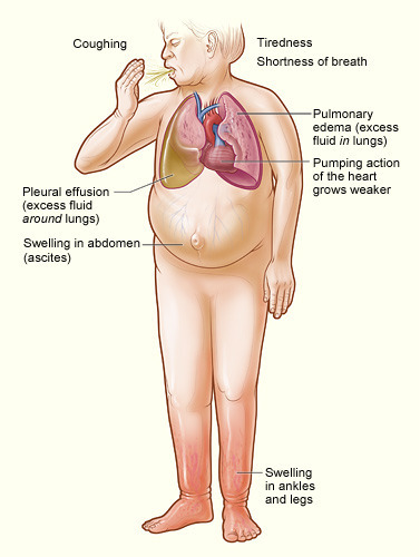 nurse-blog:  Heart failure.  Heart failure, also known as congestive heart failure or