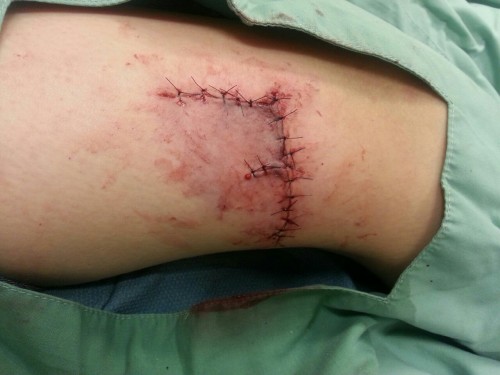 twisted-bunny: My sister was running around my grandpa’s truck, &amp; cut her leg open on 
